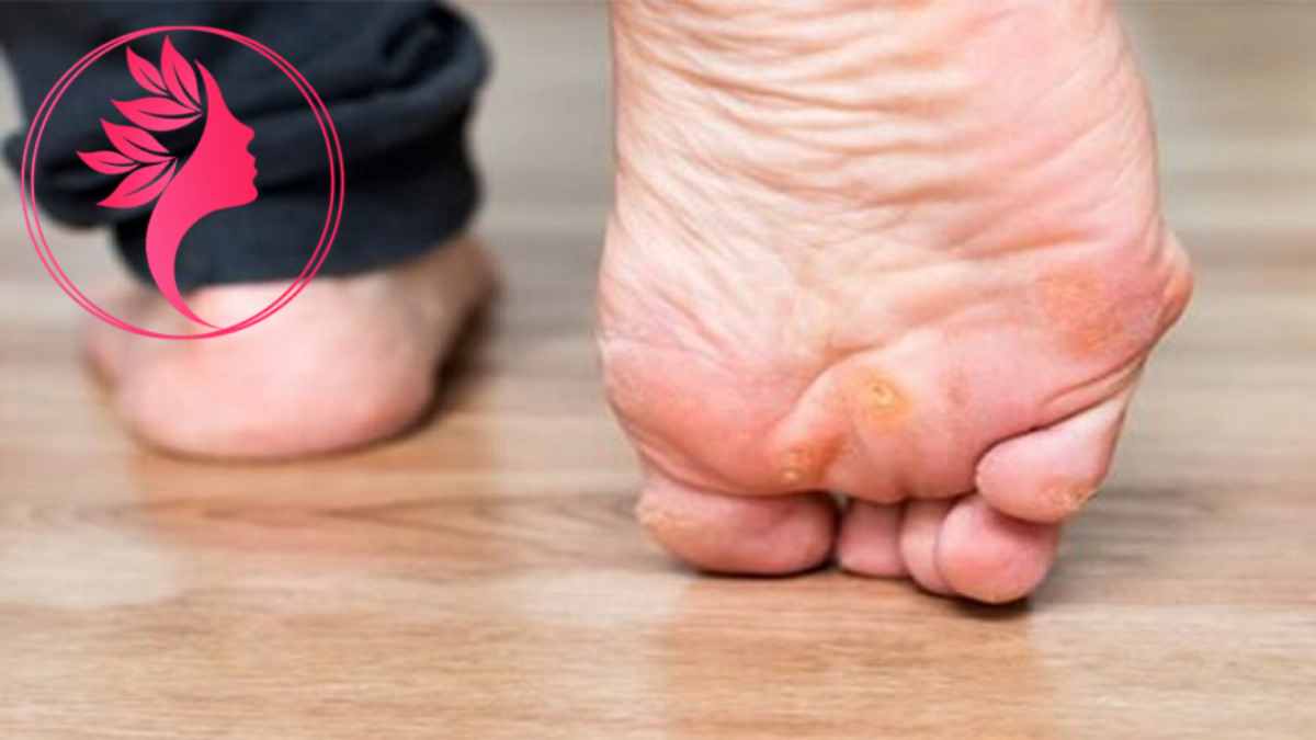 لیست بهترین مراکز درمان میخچه در آجودانیه + هزینه درمان میخچه