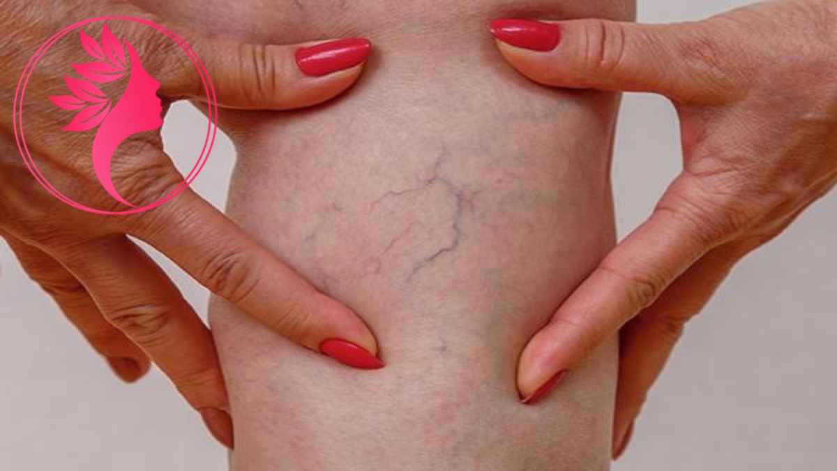 لیست بهترین مراکز درمان واریس در آجودانیه + هزینه درمان واریس