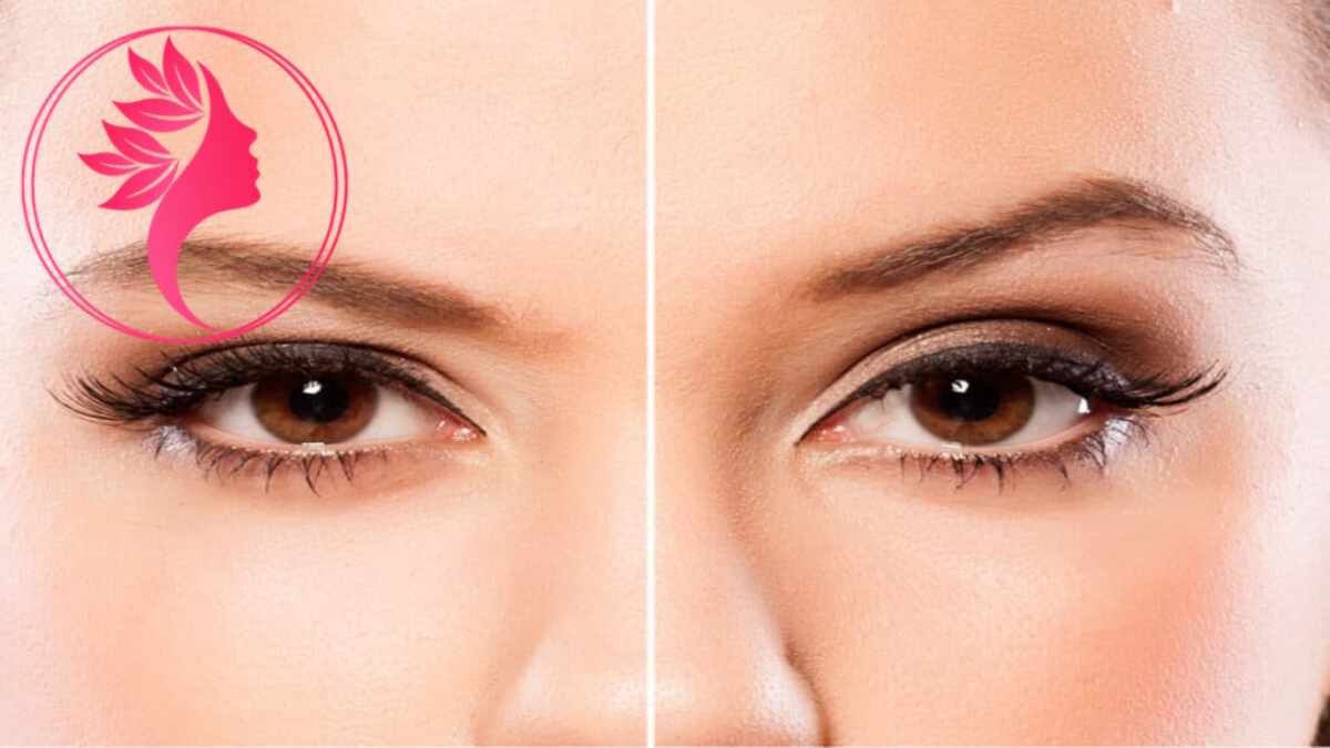 لیست بهترین مراکز جراحی لیفت ابرو در آجودانیه + هزینه جراحی لیفت ابرو
