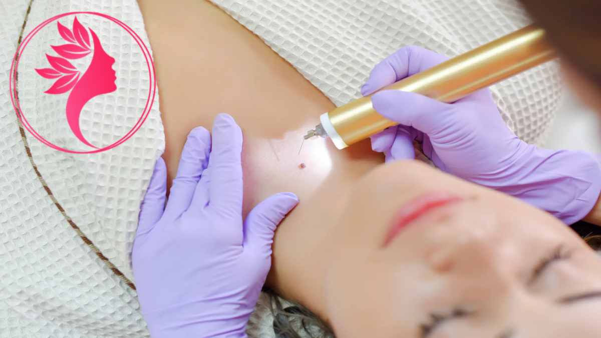 لیست بهترین مراکز برداشتن خال در آجودانیه + هزینه برداشتن خال