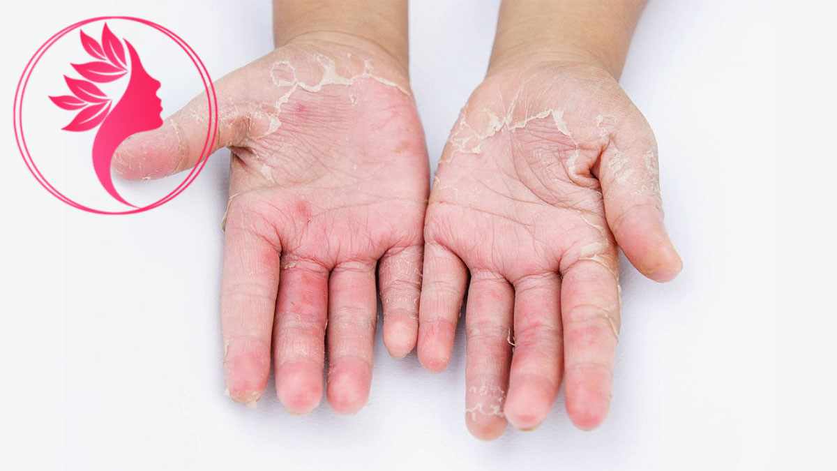 لیست بهترین مراکز درمان قارچ پوستی در ونک + هزینه درمان قارچ پوستی